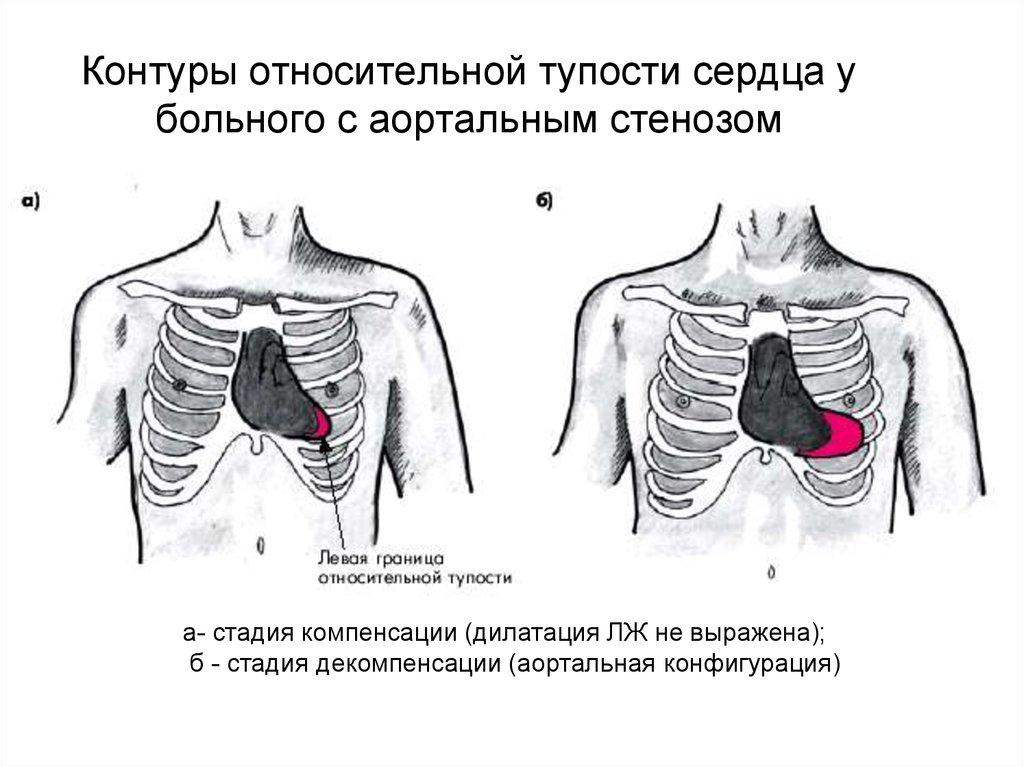 Границы относительной тупости сердца. Аортальный стеноз конфигурация сердца. Конфигурация сердца при стенозе аортального клапана. Конфигурация сердца при аортальном стенозе. Аортальная конфигурация сердца при аортальном стенозе.