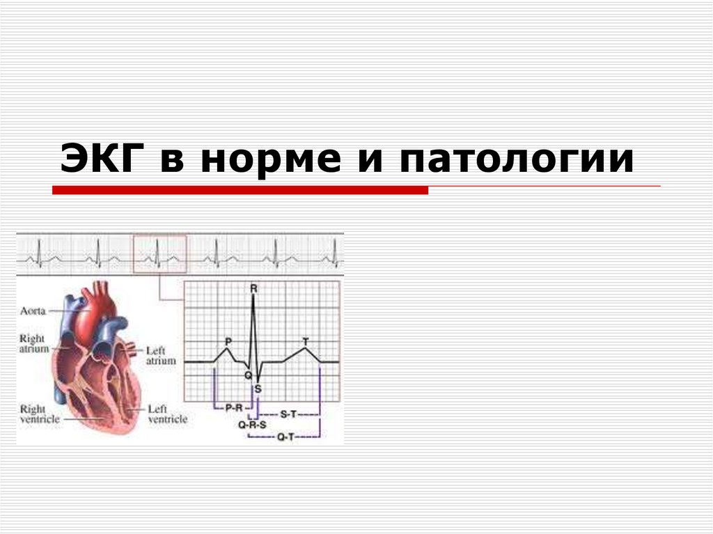 Патологии экг презентация