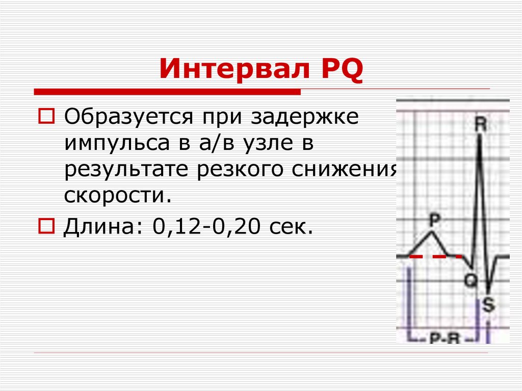 Pq на экг. Интервал PQ на ЭКГ. Длительность PQ на ЭКГ. Интервал p-q. Интервал РQ на ЭКГ.