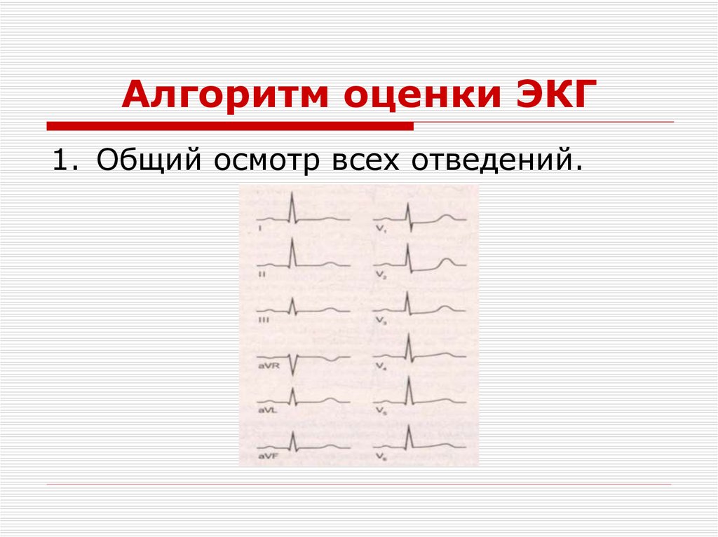 Патологии экг презентация