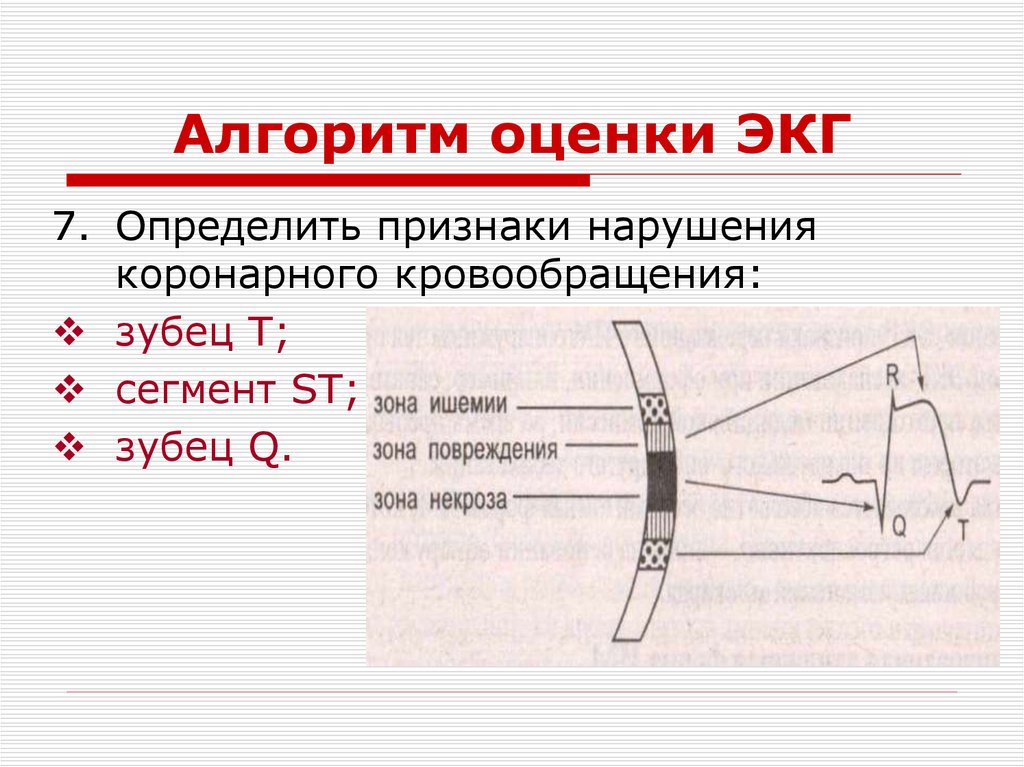 Нарушения на экг. Алгоритм оценки ЭКГ. ЭКГ алгоритм. Алгоритм оценки электрокардиограммы. Алгоритм анализа ЭКГ.