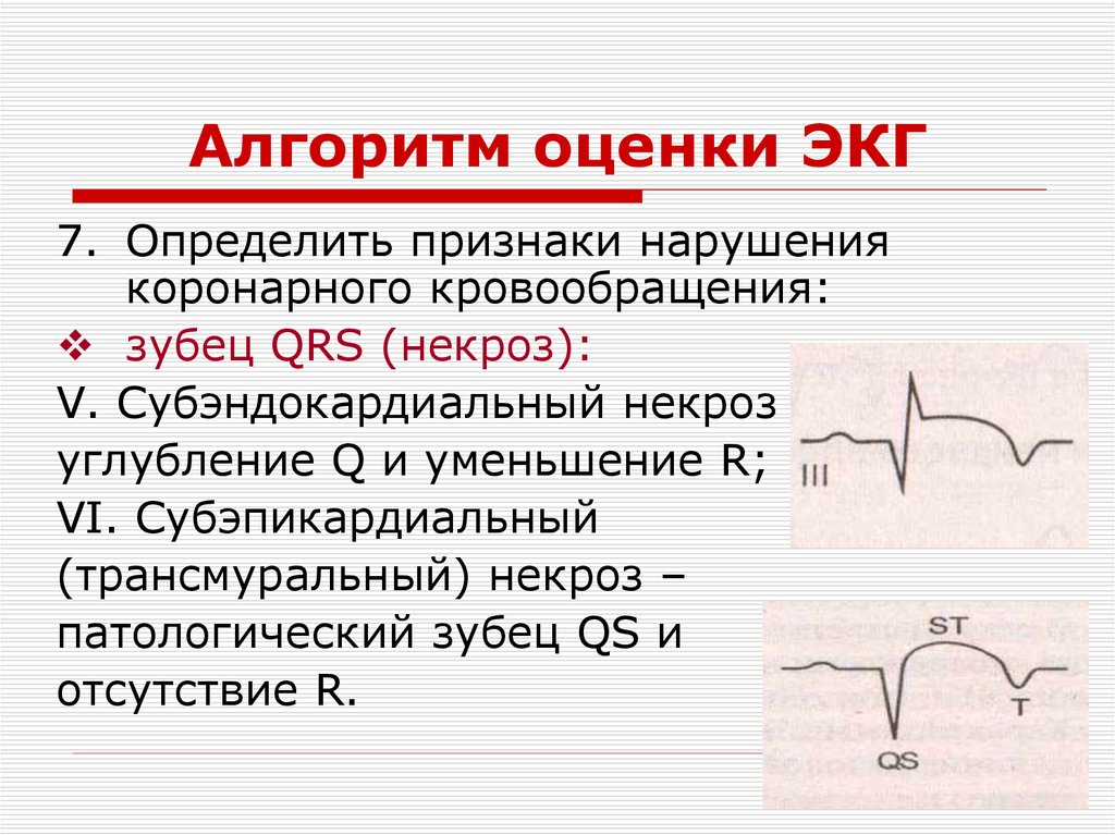 Патологии экг презентация