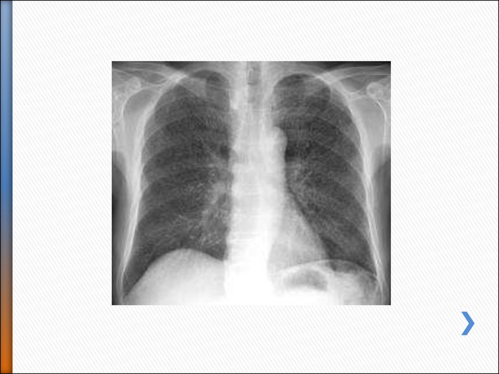Лимфогенный туберкулез. Лимфогенно диссеминированный туберкулез рентген. Гематогенно диссеминированный туберкулез рентген. Острый диссеминированный туберкулез рентген. Диссеминированный инфильтративный туберкулез.