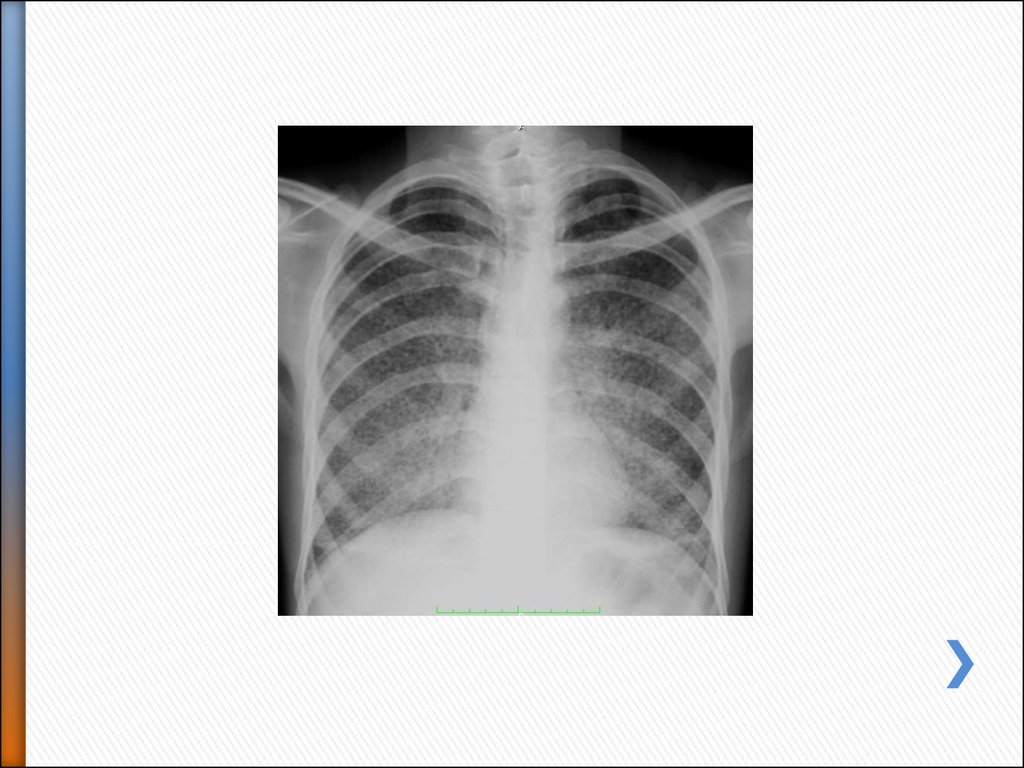 Диссеминированный туберкулез фаза инфильтрации. Острый диссеминированный туберкулез рентген. Диссеминация легких туберкулёз рентген. Диссеминация туберкулеза на рентгене. Милиарный туберкулез рентген.