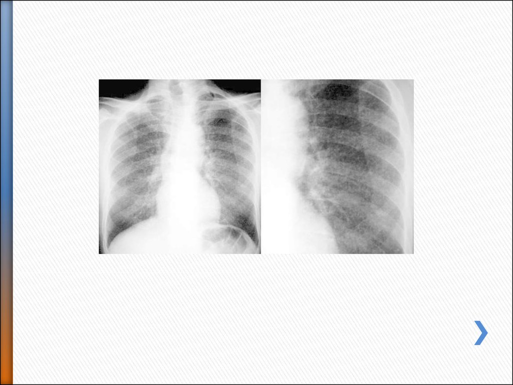 Диссеминированное поражение легких. Диссеминированный процесс в легких рентген. Диссеминированный туберкулез легких. Подострый диссеминированный туберкулез легких. Пневмоперитонеум при туберкулезе.