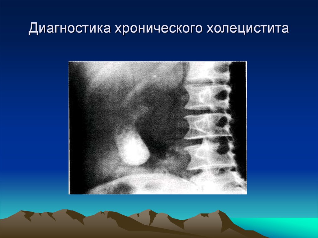 Методы диагностики холецистита. Хронический холецистит диагностика. Диагностика при хроническом холецистите. Лабораторные методы хронического холецистита. Инструментальная диагностика хронического холецистита.