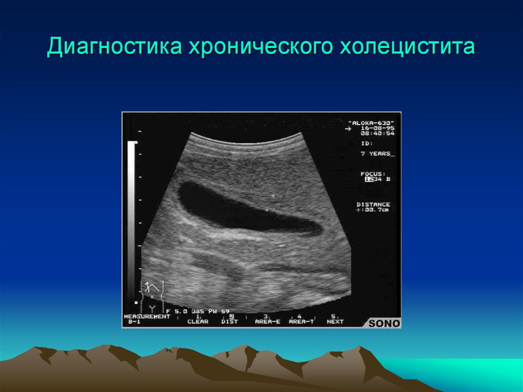 Методы диагностики холецистита. Хронический холецистит диагностика. Инструментальная диагностика хронического холецистита. Обязательный метод диагностики при хроническом холецистите. УЗИ диагностика хронического холецистита.