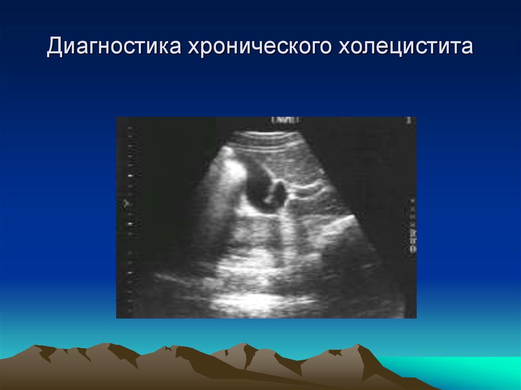 Методы исследования холецистита. Хронический холецистит диагностика. Дополнительные методы обследования при хроническом холецистите. Инструментальные методы при холецистите. Дополнительные исследования при холецистите.