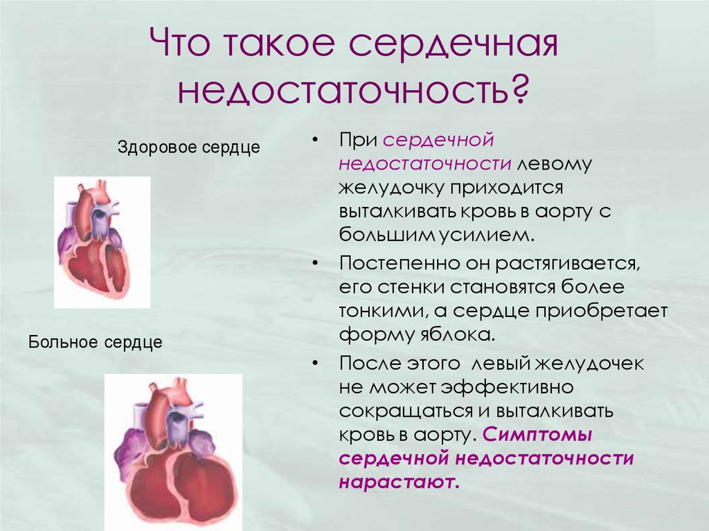 Сердцем отличай. Сердечная недостаточность. Сердце при сердечной недостаточности. Изменение сердца при ХСН. Левосторонняя сердечная недостаточность.