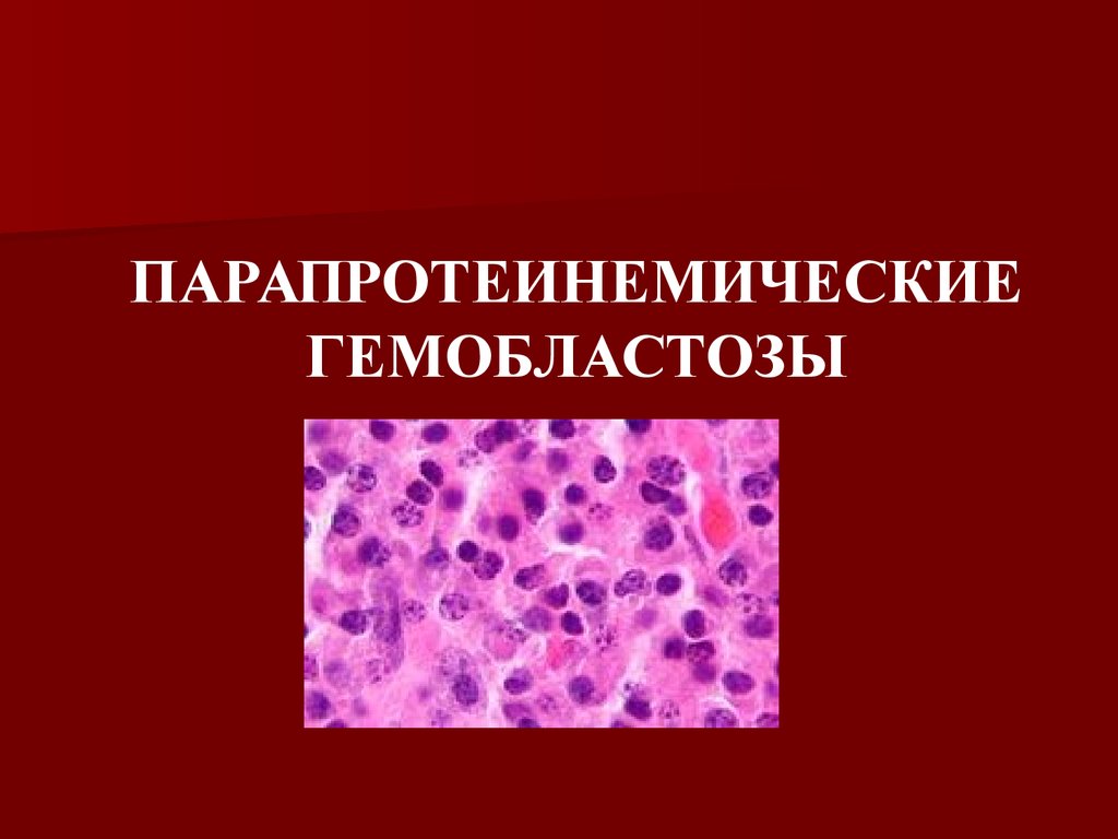 Гемобластозы это. Гемобластозы патологическая анатомия. Протеинемические гемобластозы. Парапротеинемические Парапротеинемические гемобластозы. Гемобластозы презентация.