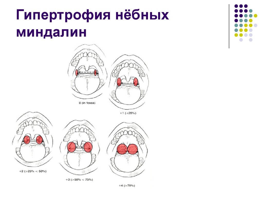 Тонзиллит у детей мкб. Гипертрофия миндалин 2 3 степени у ребенка. Степени увеличения небных миндалин. Степени гипертрофии небных миндалин. Гипертрофия небных миндалин 2 степени у ребенка.