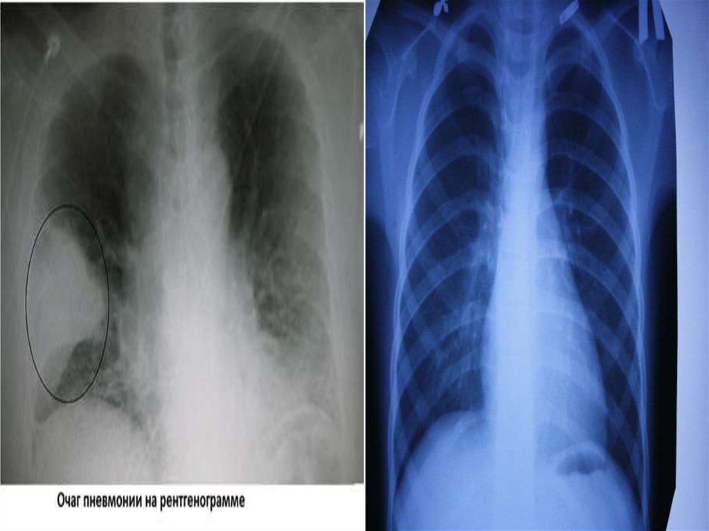 Пневмония фото легких. Бронхит и пневмония на рентгене. Острый бронхит рентгенограмма. Обструктивный бронхит рентгенограмма. Рентгенография хронический обструктивный бронхит.