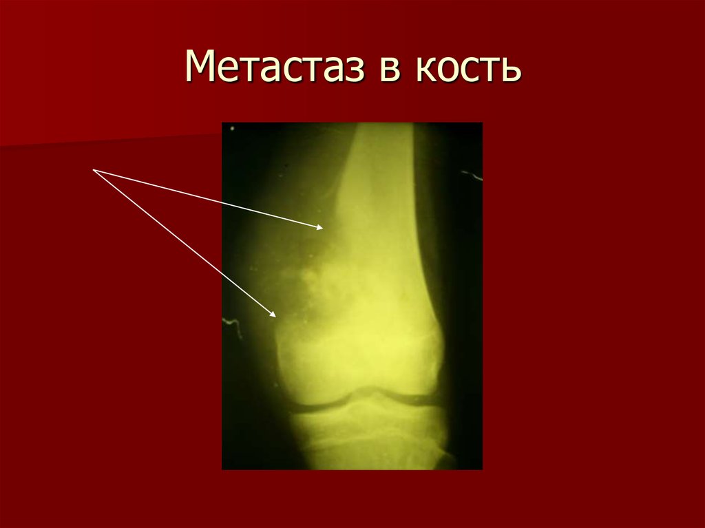 Метастатическое поражение кости. Метастазы в бедренную кость. Метастатические опухоли костей.