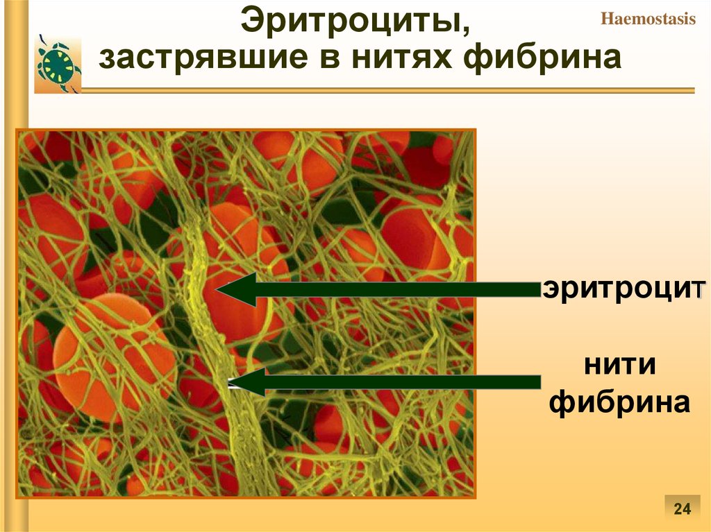 Фибрин это. Эритроциты застрявшие в нитях фибрина. Эритроциты в нитях фибрина. Образование нитей фибрина.