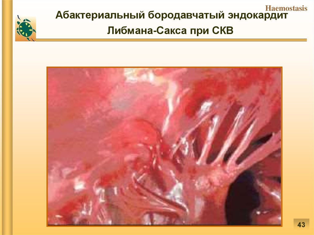 Абактериальный бородавчатый эндокардит Либмана-Сакса при СКВ 