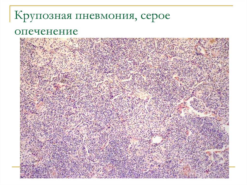 Крупозная пневмония патологическая анатомия презентация