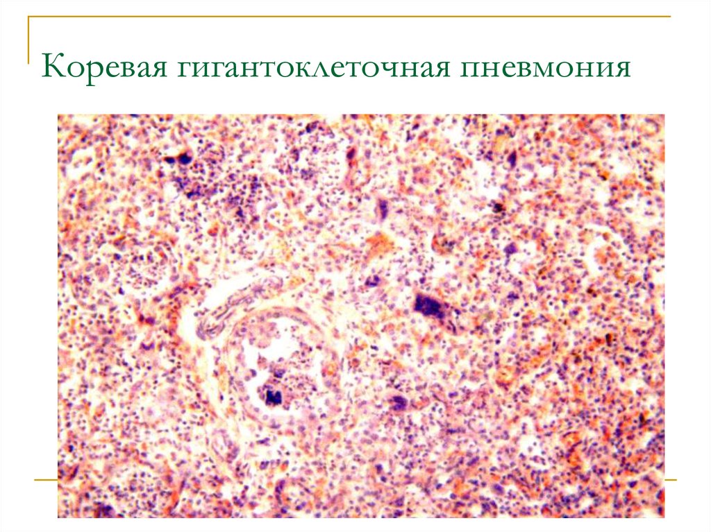 Очаговая пневмония рисунок микропрепарат