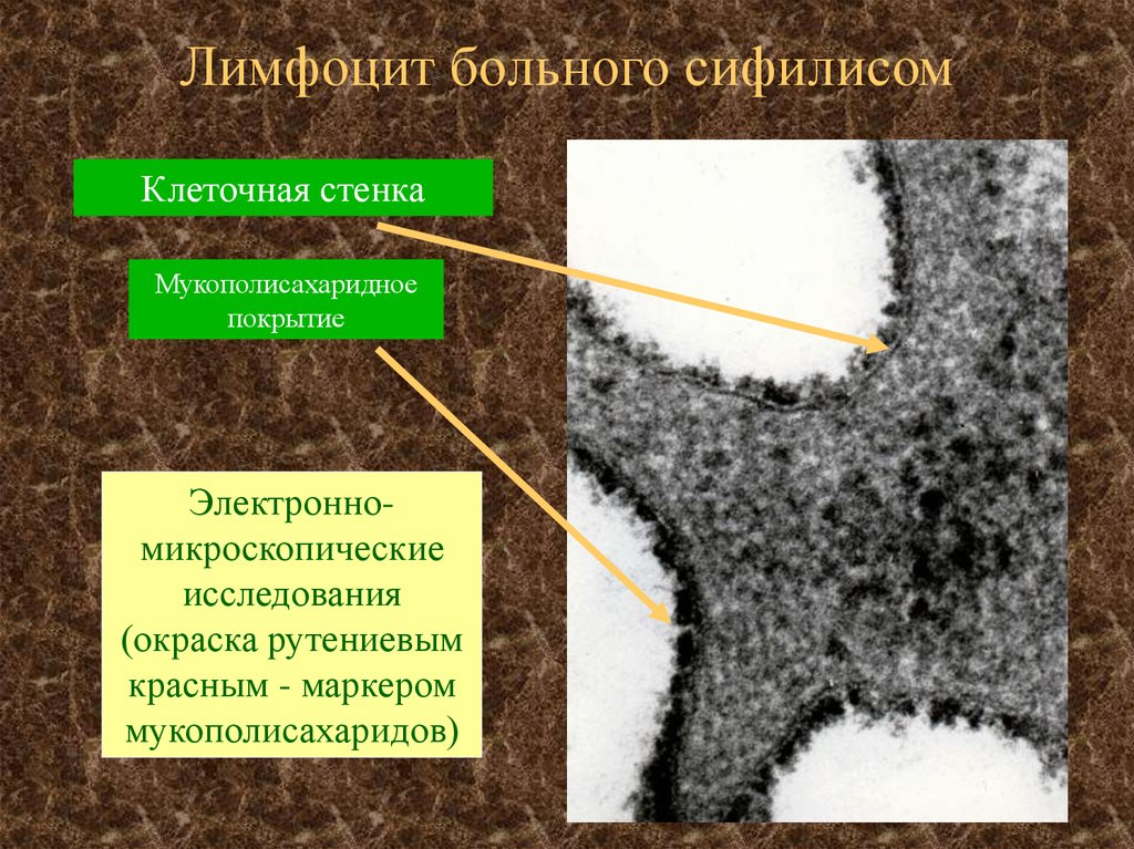 Лимфоцит больного сифилисом
