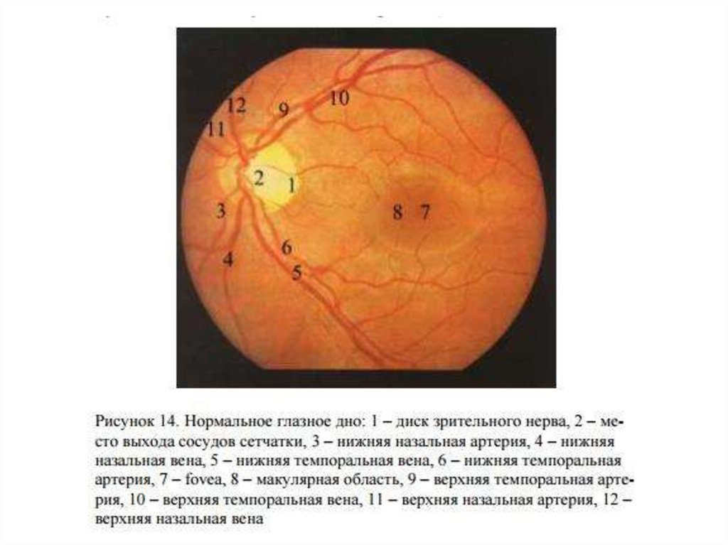 Норма глазного дна. Глазное дно при офтальмоскопии норма. Глазное дно норма рисунок. Схема глазного дна при обратной офтальмоскопии. Осмотр глазного дна описание нормы.