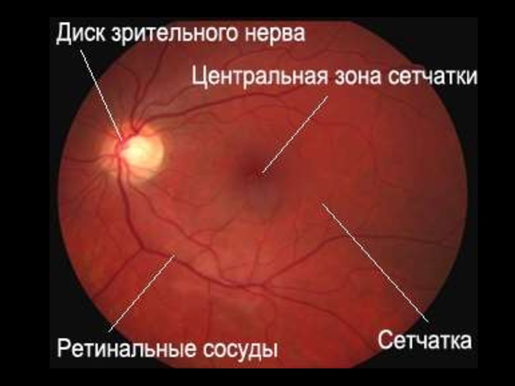 Норма глазного дна. Офтальмоскопия глазного дна норма. Зрительный нерв глазное дно норма. Глазное дно при офтальмоскопии норма. Диск зрительного нерва в норме.
