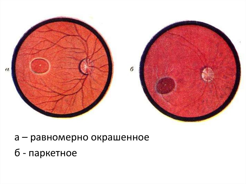 Глазное дно презентации