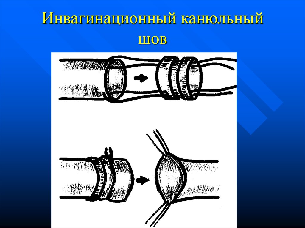 Сосудистый шов методы наложения. Инвагинационный сосудистый шов. Наложение сосудистого шва.