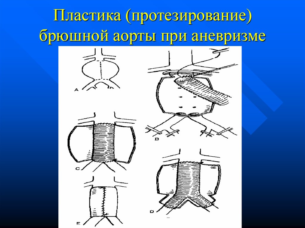 Аневризма аорты операция. Разрезы при операциях на аорте. Операции при аневризмах сосудов.