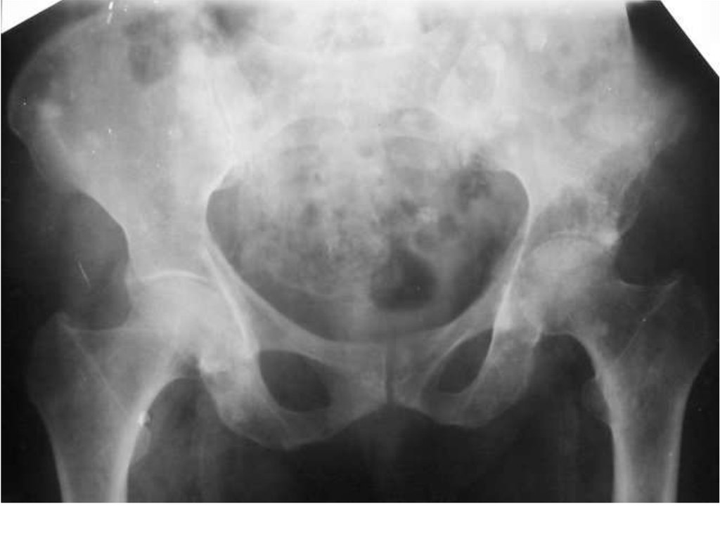 Изменения костей таза. Остеобластические метастазы в кости таза рентген. Метастазы костей таза рентген. Остеобластические метастазы в кости таза на рентгенограмме. Метастазы в бедренной кости рентген.