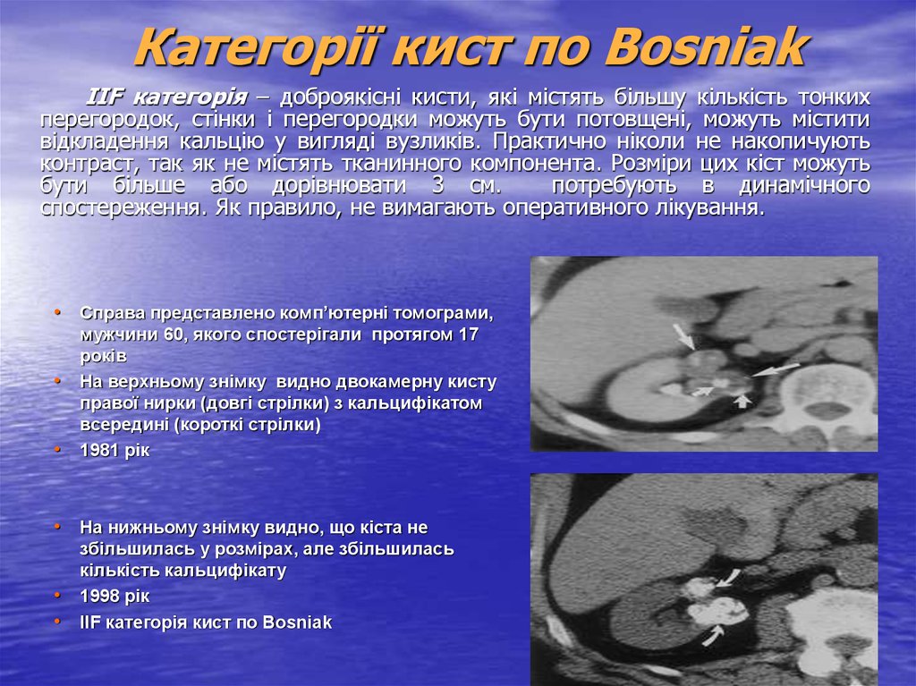 Кисты почек по босняк. Кисты почек по Босниак мрт. Босниак классификация кисты почек. Киста почки Босниак 4.