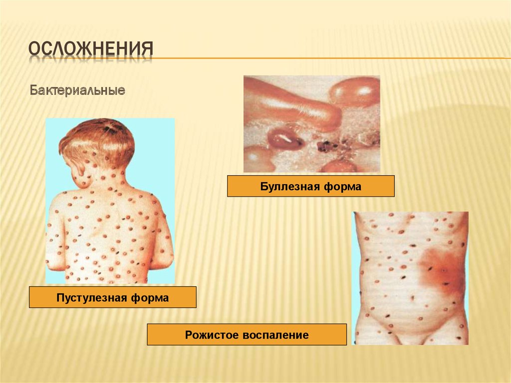 Натуральная оспа картинки