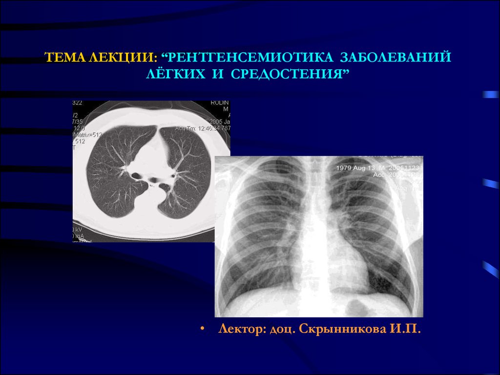 Лучевая диагностика средостения презентация