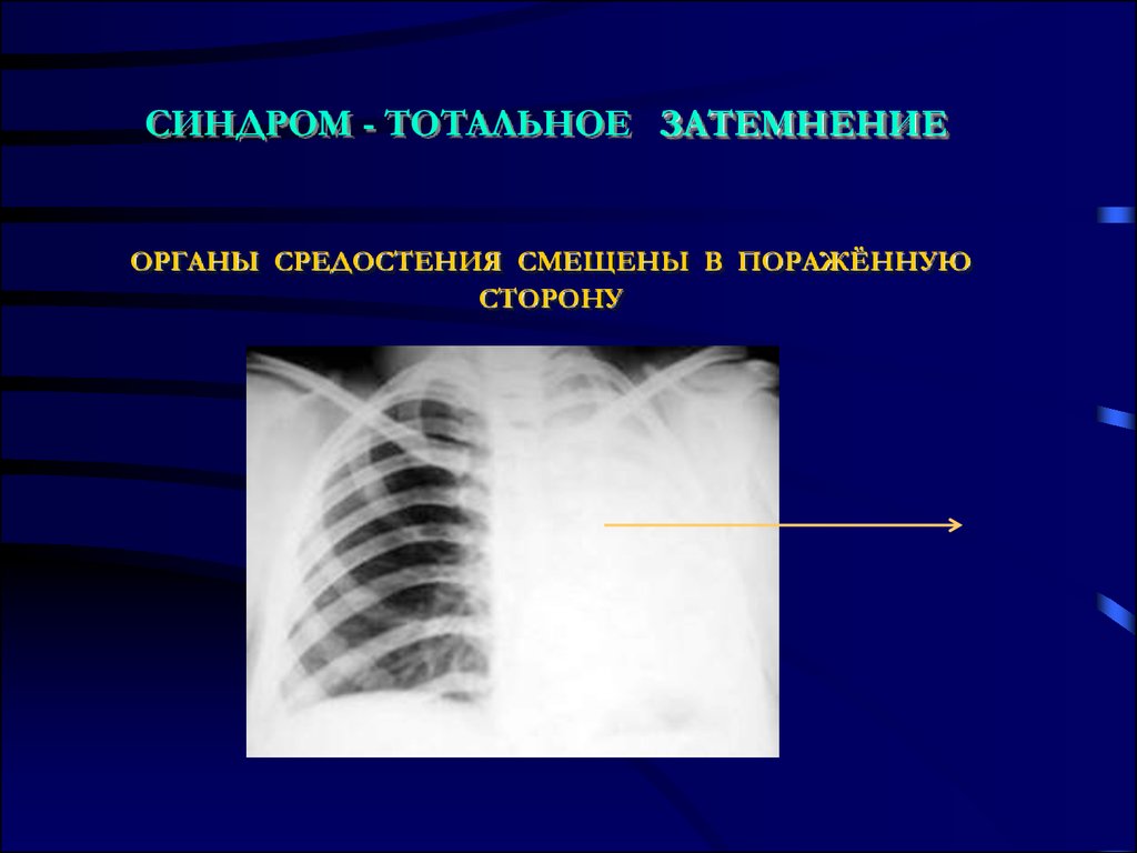 Аномальная картина 1 степени. Синдром тотального затемнения легочного поля. Рентген тотальное затемнение легкого. Образование верхнего средостения. Смещение органов средостения в здоровую сторону.