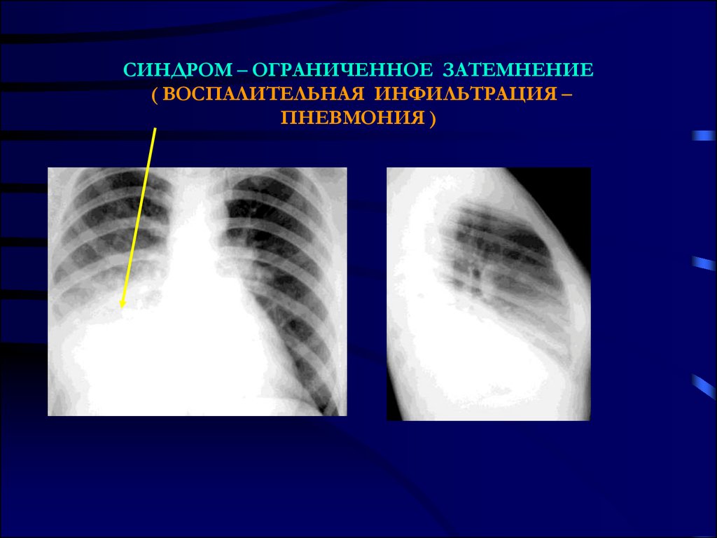 Пневмония синдромы. Синдром инфильтрации легочной ткани рентген. Синдром ограниченного затемнения легочного поля рентген. Синдром ограниченного затемнения легочной ткани. Ограниченное затемнение рентген легких.