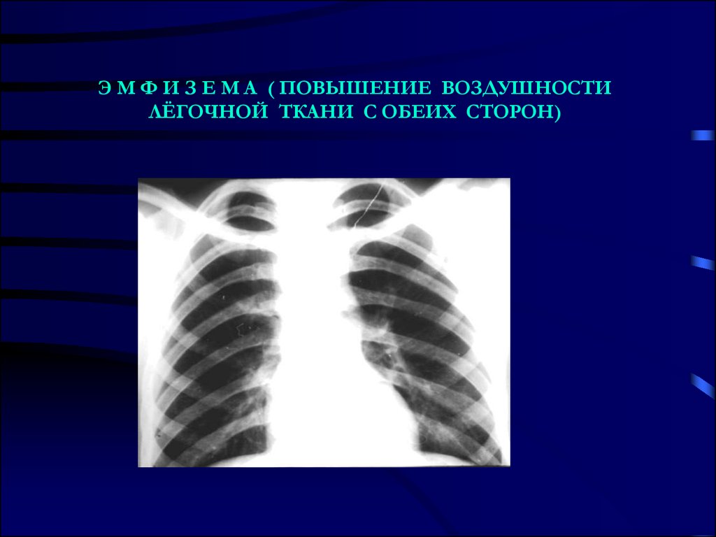 Увеличение легких. Синдром повышенной воздушности легочной ткани рентген. Снижена пневматизация легочной ткани. Синдром повышенной воздушности легких рентген. Повышена воздушность легочных тканей.