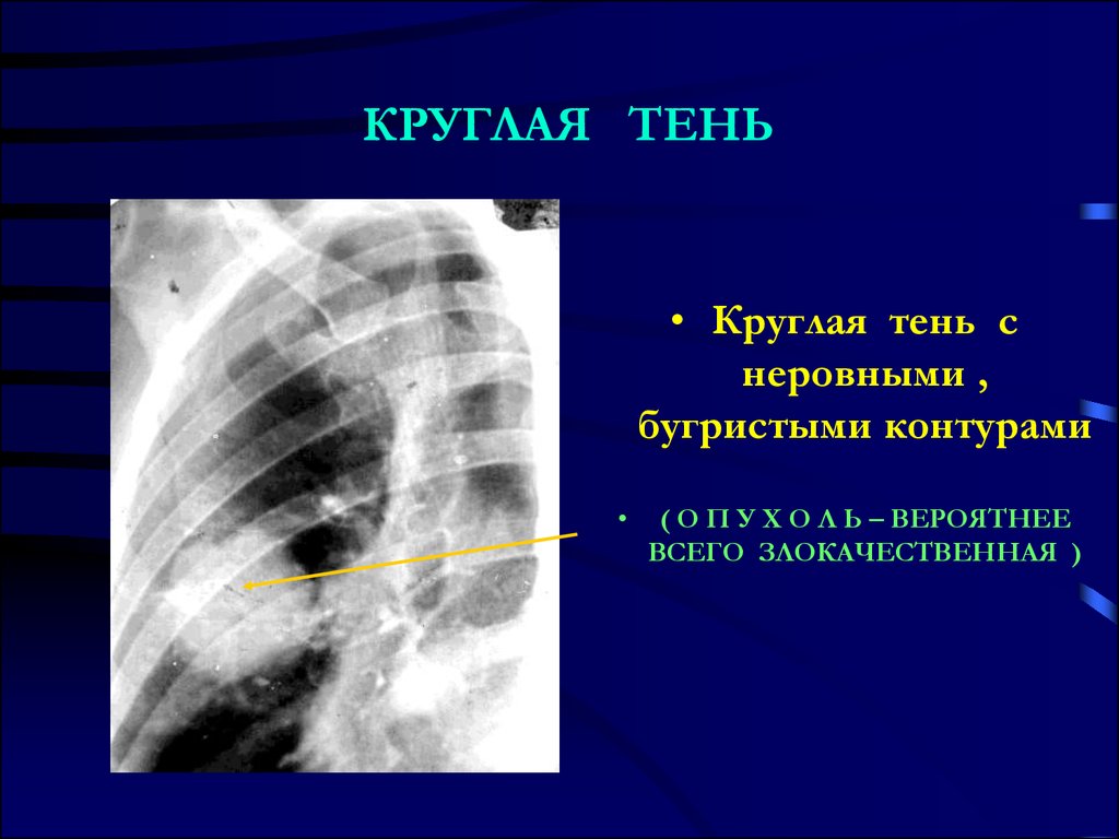 Субсолидные узелки. Круглое образование в легком. Круглая тень с неровными контурами. Неровное образование с бугристым контуром.