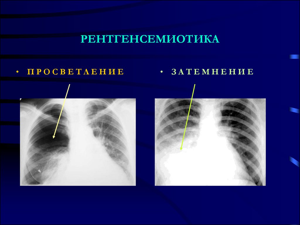 Негативное изображение рентген