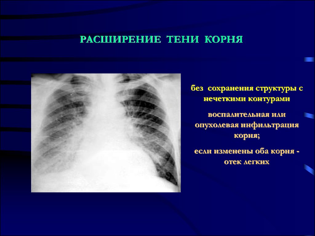 Лучевая диагностика средостения презентация