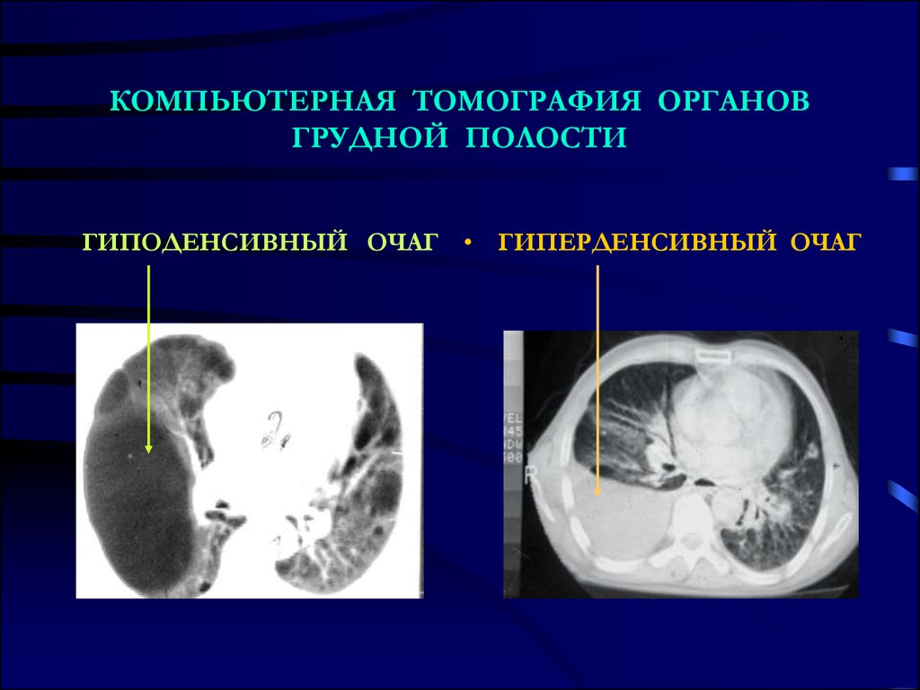 Кт грудной полости. Гиподенсивный очаг в легких при кт. Гиперденсивный очаг. Компьютерная томография органов грудной полости.