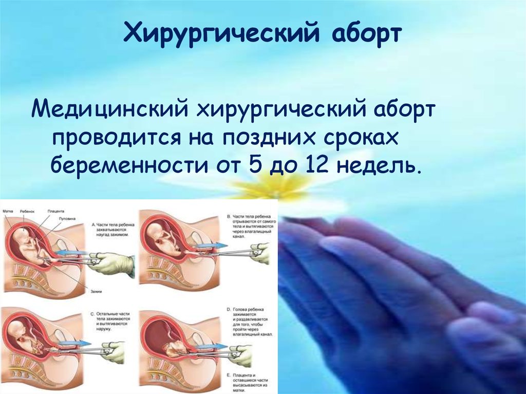 Можно недели. Хирургический аборт на 6 неделе беременности. Хирургический аборт на 12 неделе. Хирургический аборт сроки. Методика проведения аборта.