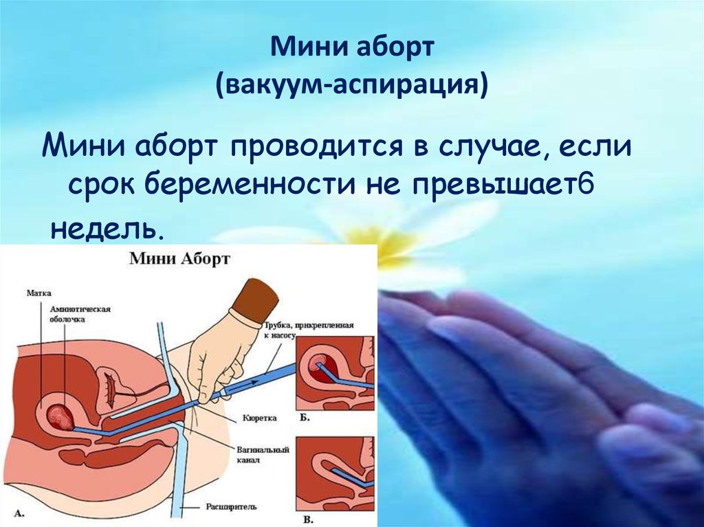 Мини аборт