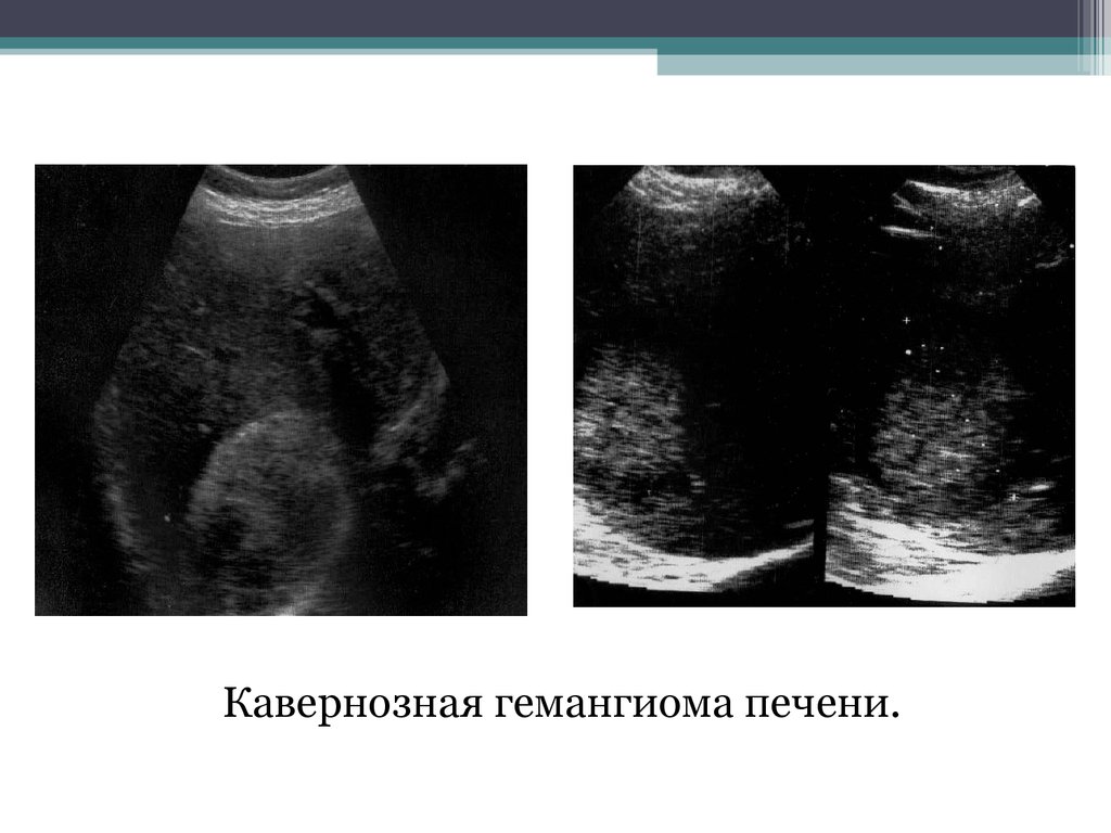 Гемангиома печени что это. Гемангиома печени макропрепарат. УЗИ картина кавернозной гемангиомы печени. Кавернозная гемангиома печени микроскопия. Гемангиома печени патанатомия.