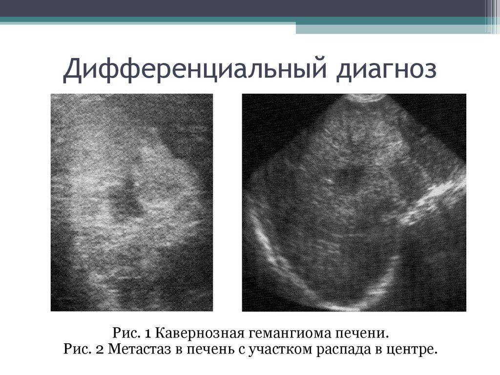 Эхографическая картина первичного рака печени характеризуется тест