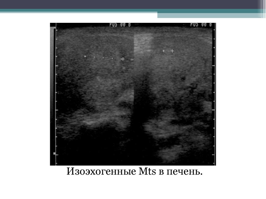 Изоэхогенное образование с четкими контурами