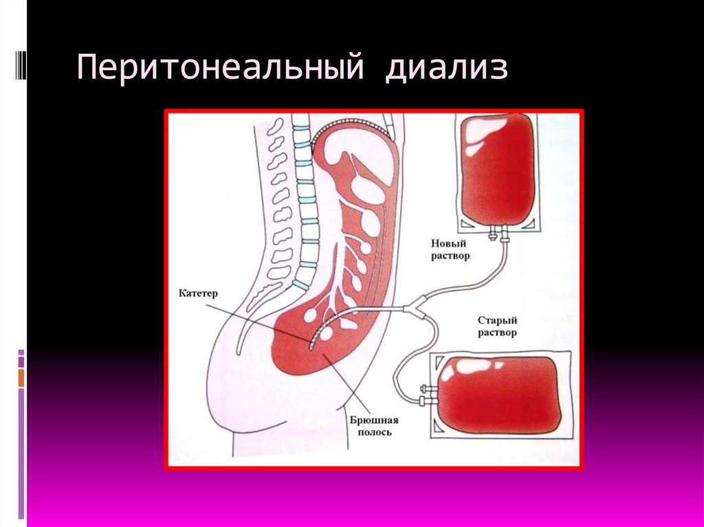 Перитонеальный диализ что это. Методика проведения перитонеального диализа. Схема перитонеального диализа. Гемодиализ и перитонеальный диализ.