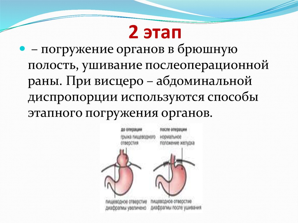 Диафрагмальная грыжа. Висцеро абдоминальная диспропорция. Ушивание диафрагмальной грыжи. Врожденная диафрагмальная грыжа. Диафрагмальная грыжа брюшной полости.