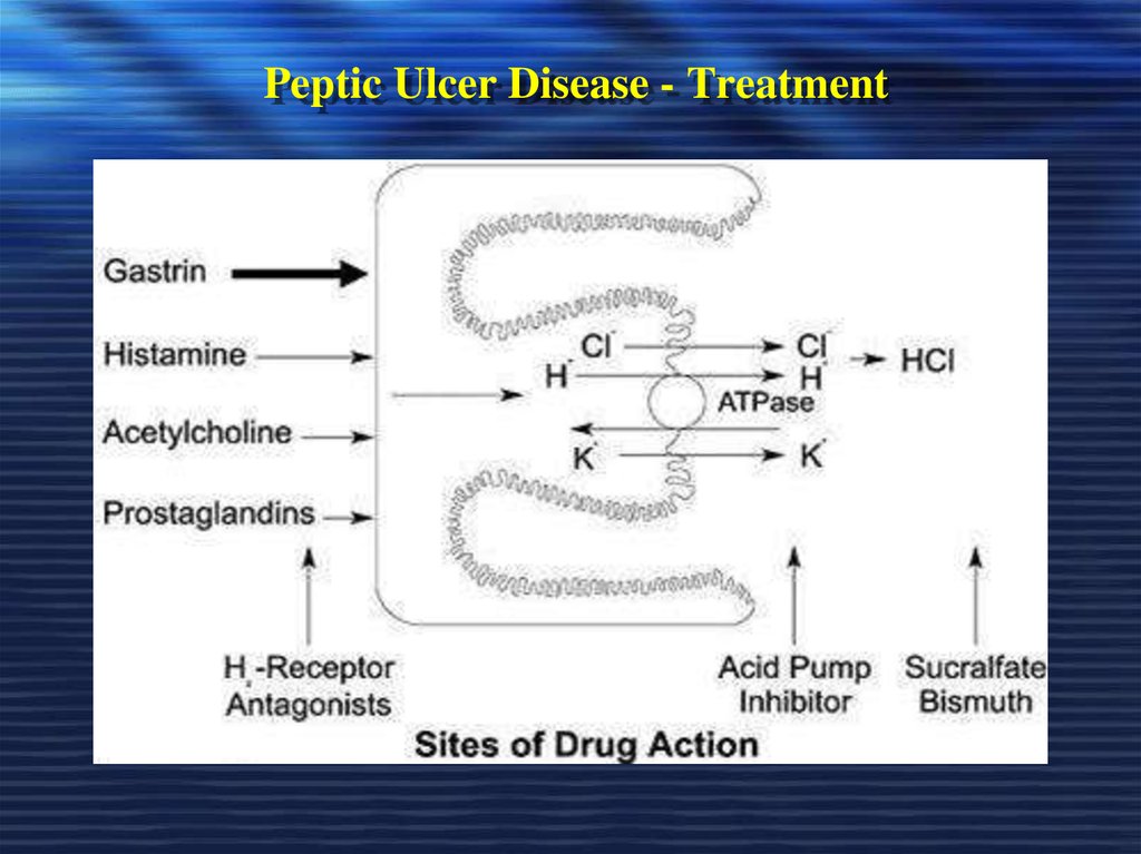Peptic Ulcer Disease - Treatment