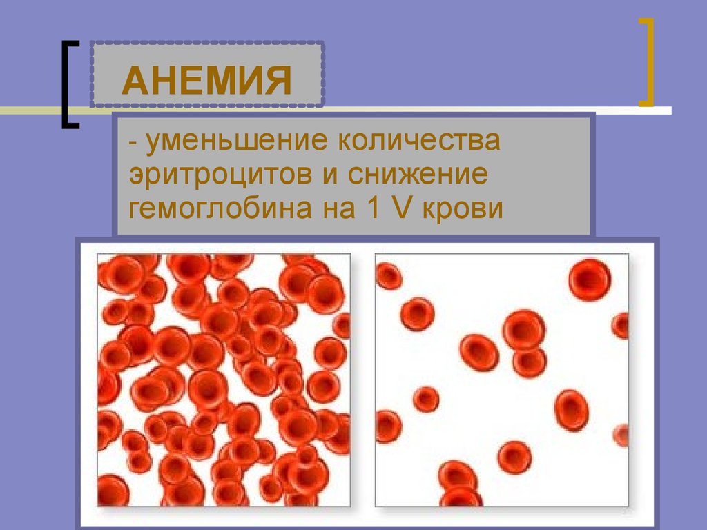 Анемия и эритроциты в крови. Анемия эритроциты и гемоглобин. Снижение эритроцитов и гемоглобина анемия. Уменьшение эритроцитов. Уменьшение количества эритроцитов.
