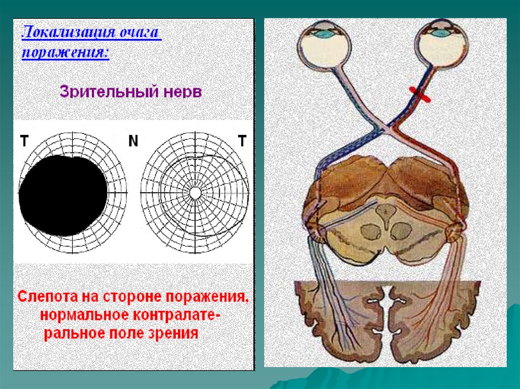 Путь зрительного нерва схема