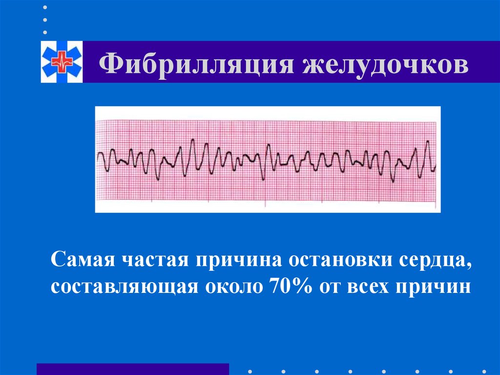 Фибрилляция желудочков на экг фото с заключением