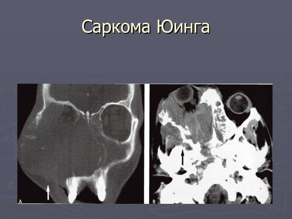 Саркома юинга презентация